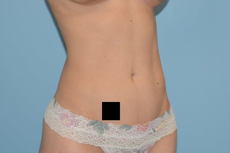 Liposuction Before & After Gallery - Patient 12898904 - Image 4