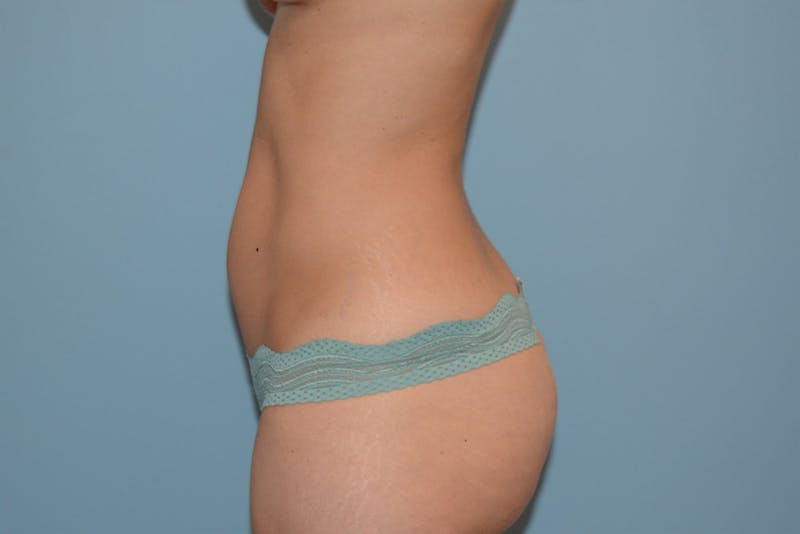 Liposuction Before & After Gallery - Patient 12898904 - Image 5