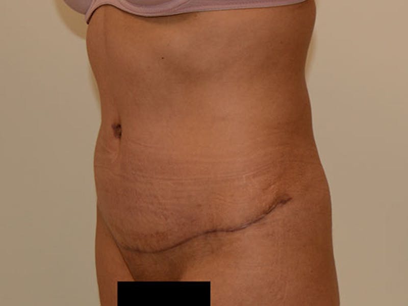 Tummy Tuck Before & After Gallery - Patient 12898902 - Image 8