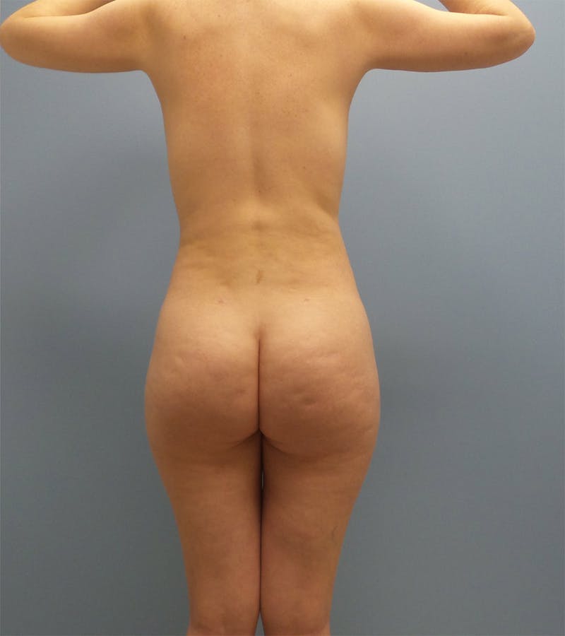 Brazilian Butt Lift Before & After Gallery - Patient 12898905 - Image 2