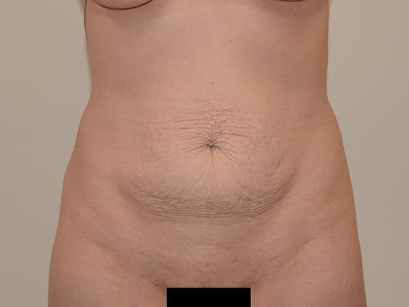 Tummy Tuck Gallery - Patient 12898906 - Image 1