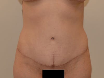 Tummy Tuck Before & After Gallery - Patient 12898906 - Image 2