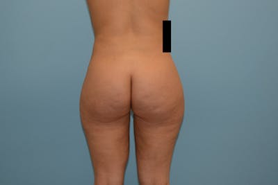 Liposuction Before & After Gallery - Patient 12898909 - Image 2