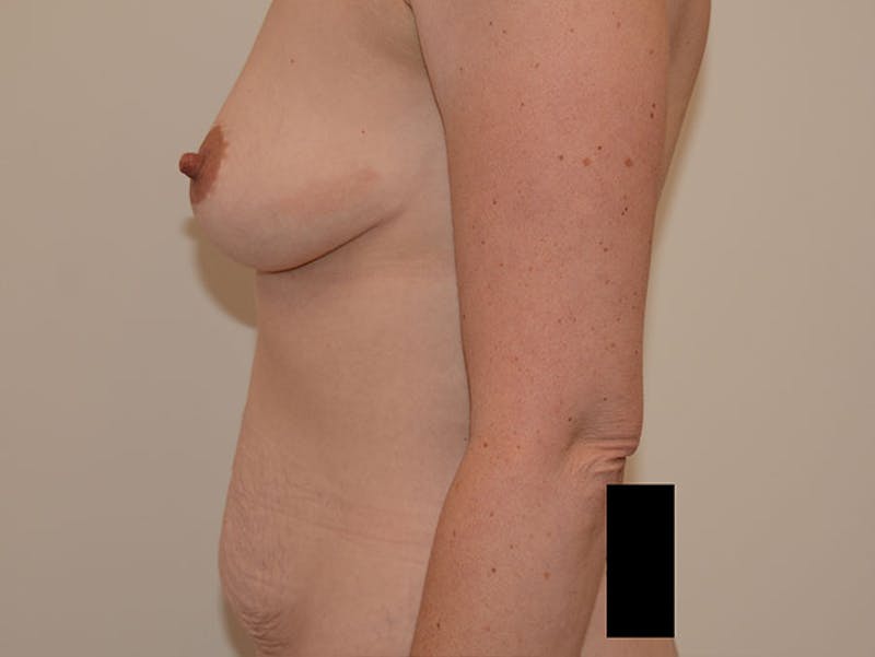 Tummy Tuck Before & After Gallery - Patient 12898906 - Image 3