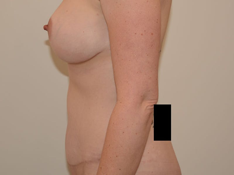 Tummy Tuck Before & After Gallery - Patient 12898906 - Image 4