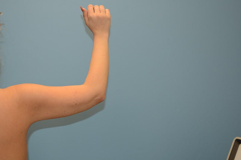 Liposuction Before & After Gallery - Patient 12898909 - Image 6
