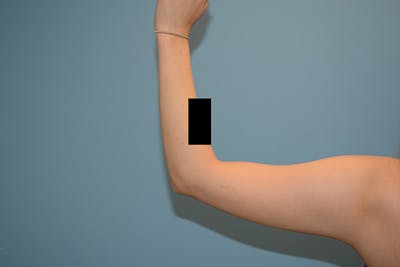 Liposuction Before & After Gallery - Patient 12908912 - Image 1
