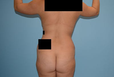 Brazilian Butt Lift Before & After Gallery - Patient 12917424 - Image 1