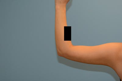 Liposuction Before & After Gallery - Patient 12908912 - Image 2