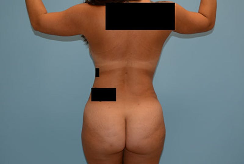 Brazilian Butt Lift Before & After Gallery - Patient 12917424 - Image 2