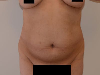Liposuction Before & After Gallery - Patient 12917425 - Image 1