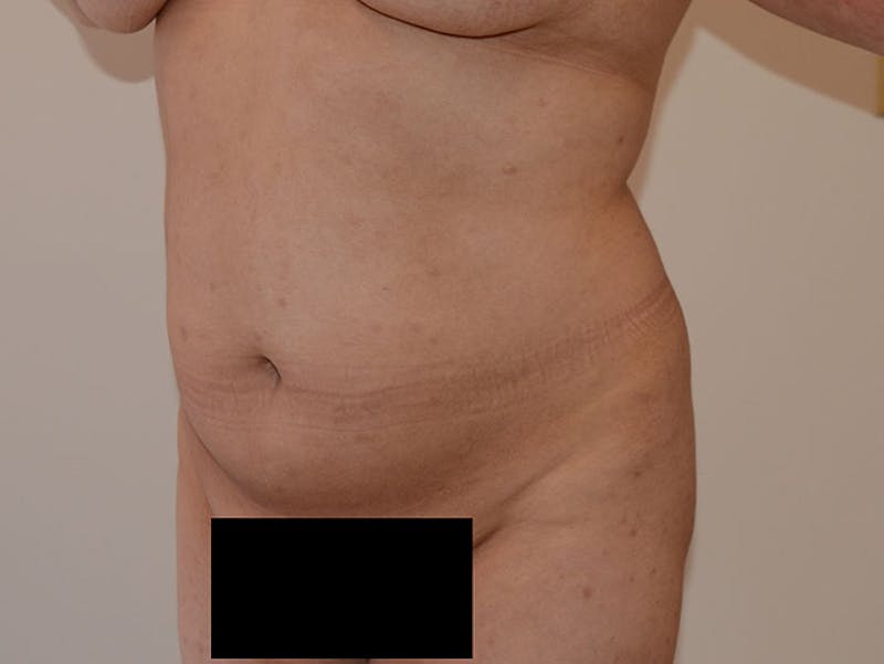 Liposuction Gallery - Patient 12917425 - Image 3