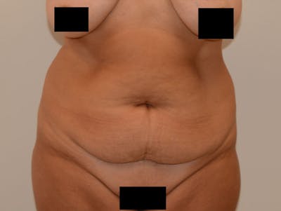 Liposuction Before & After Gallery - Patient 12917427 - Image 1