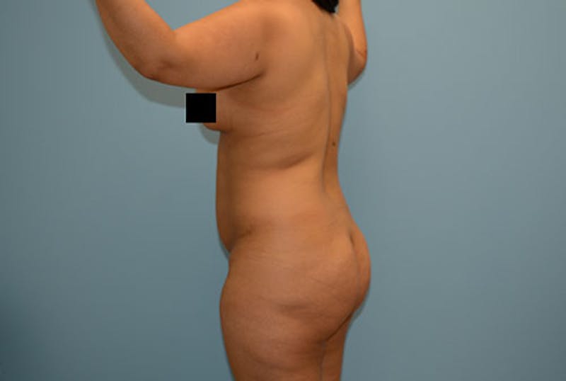 Brazilian Butt Lift Before & After Gallery - Patient 12917428 - Image 5