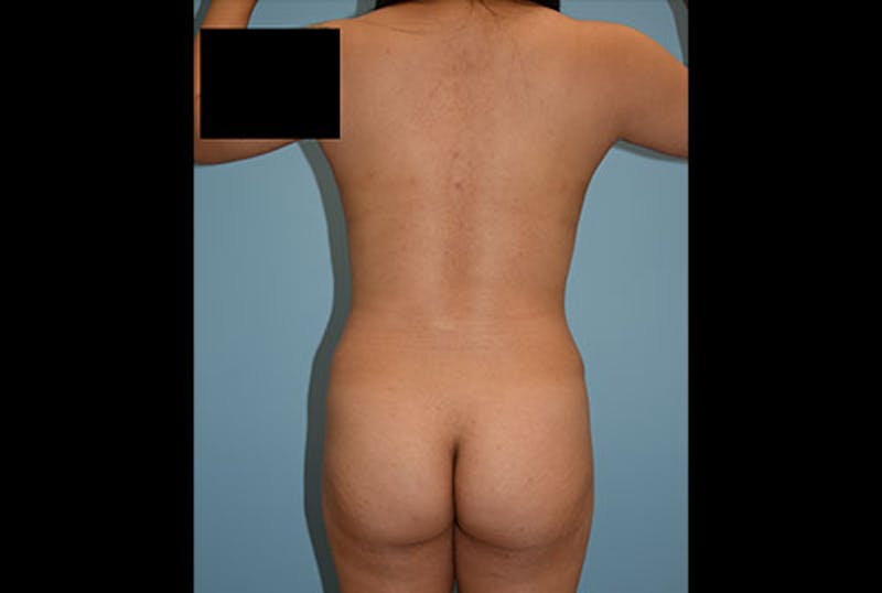 Brazilian Butt Lift Before & After Gallery - Patient 12917432 - Image 1