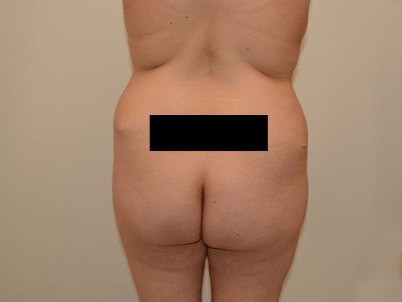 Liposuction Before & After Gallery - Patient 12917430 - Image 3