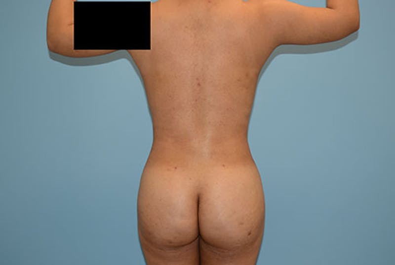 Brazilian Butt Lift Before & After Gallery - Patient 12917432 - Image 2