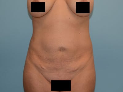 Liposuction Before & After Gallery - Patient 12917431 - Image 1