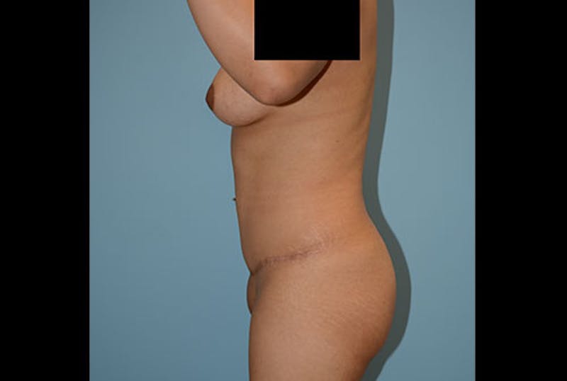 Brazilian Butt Lift Before & After Gallery - Patient 12917432 - Image 5