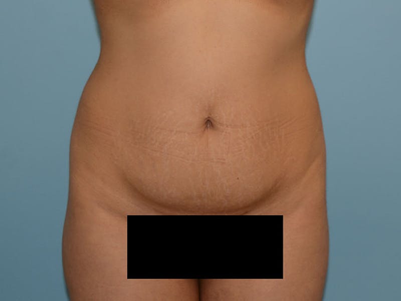 Mommy Makeover Before & After Gallery - Patient 12917433 - Image 7