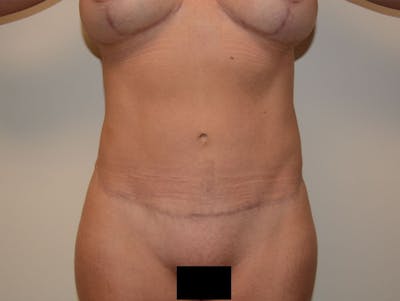 Liposuction Before & After Gallery - Patient 12917431 - Image 2