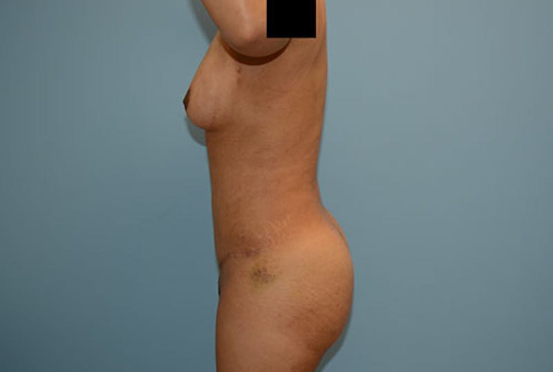 Brazilian Butt Lift Before & After Gallery - Patient 12917432 - Image 6