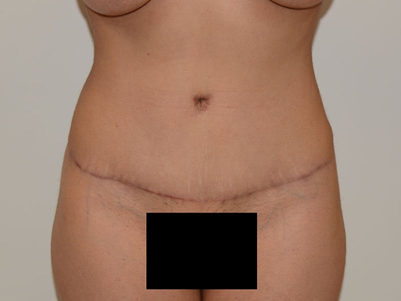 Mommy Makeover Before & After Gallery - Patient 12917433 - Image 8