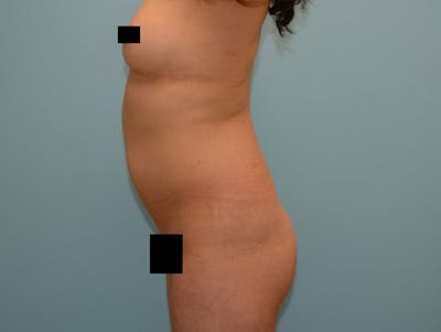 Liposuction Before & After Gallery - Patient 12917434 - Image 1