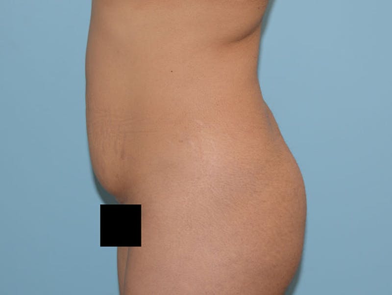 Mommy Makeover Before & After Gallery - Patient 12917433 - Image 9