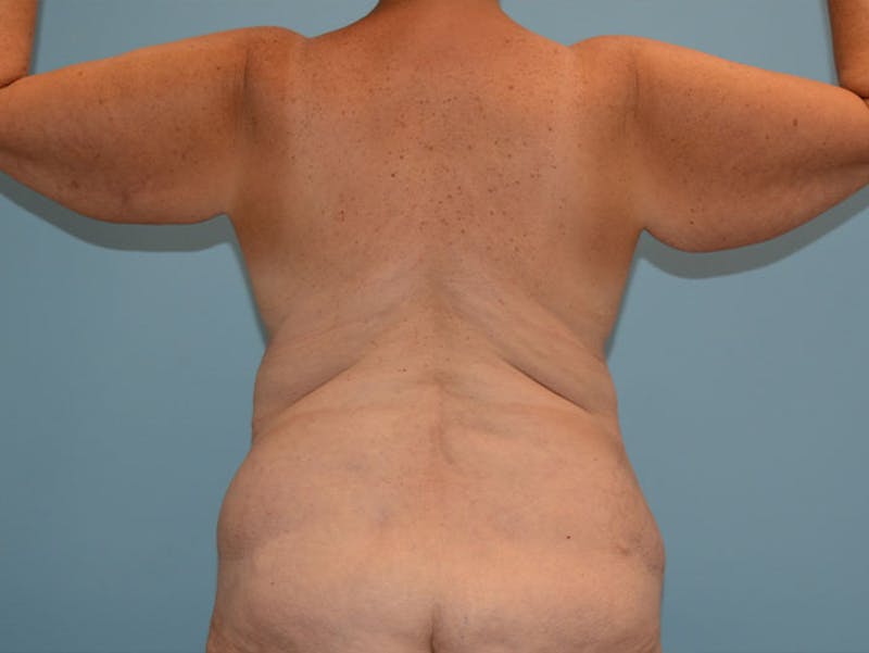 Liposuction Before & After Gallery - Patient 12917438 - Image 1