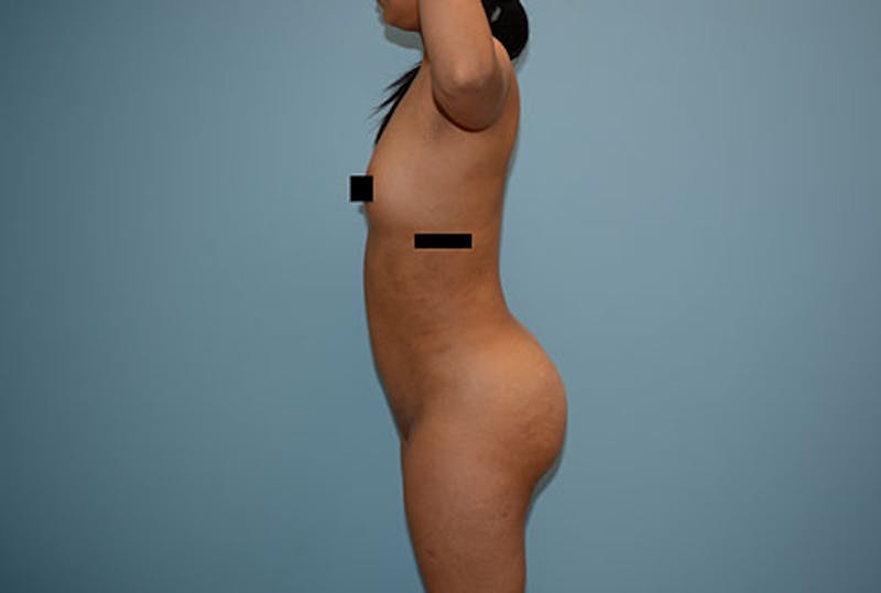 Brazilian Butt Lift Before & After Gallery - Patient 12917435 - Image 6