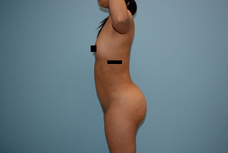 Brazilian Butt Lift Gallery - Patient 12917435 - Image 6