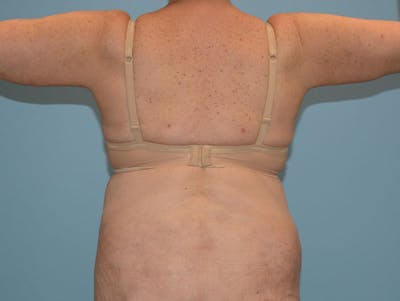 Liposuction Before & After Gallery - Patient 12917438 - Image 2