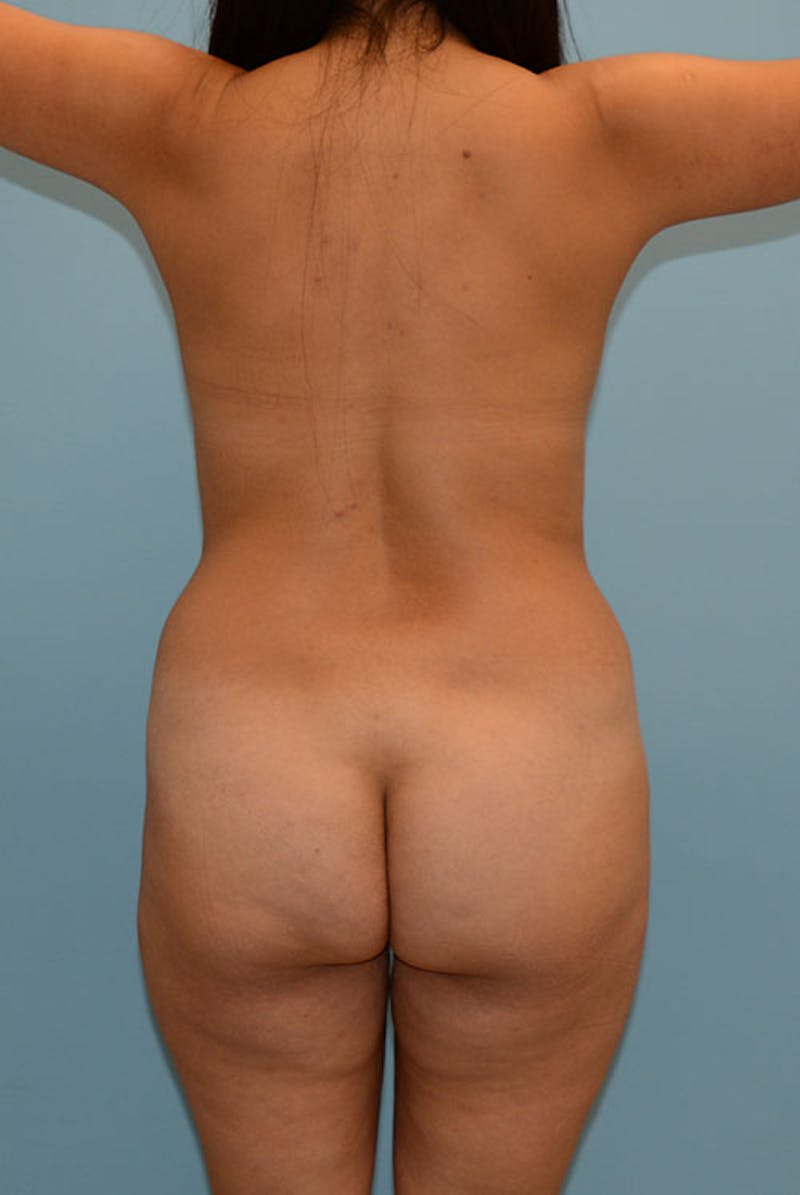 Brazilian Butt Lift Before & After Gallery - Patient 12917442 - Image 1