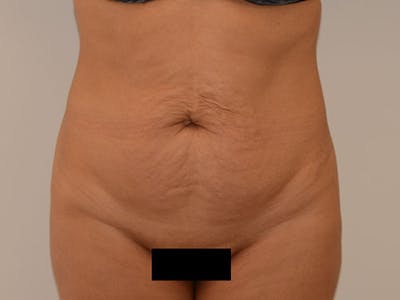 Liposuction Before & After Gallery - Patient 12917452 - Image 1