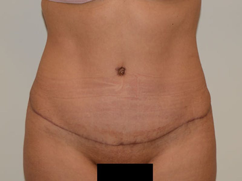 Liposuction Gallery - Patient 12917452 - Image 2