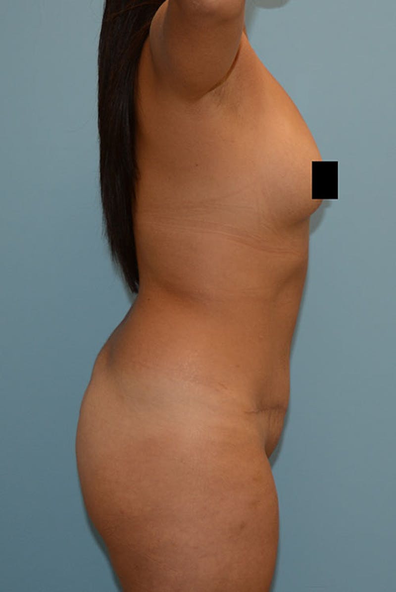 Brazilian Butt Lift Before & After Gallery - Patient 12917442 - Image 5