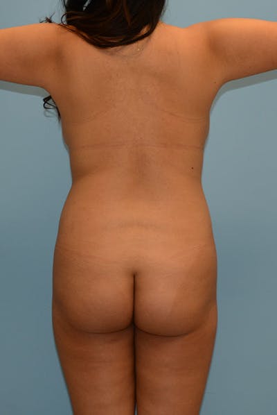 Brazilian Butt Lift Before & After Gallery - Patient 12917456 - Image 1