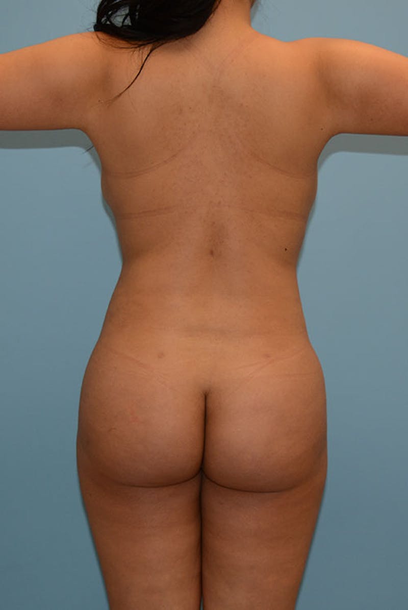 Brazilian Butt Lift Before & After Gallery - Patient 12917456 - Image 2