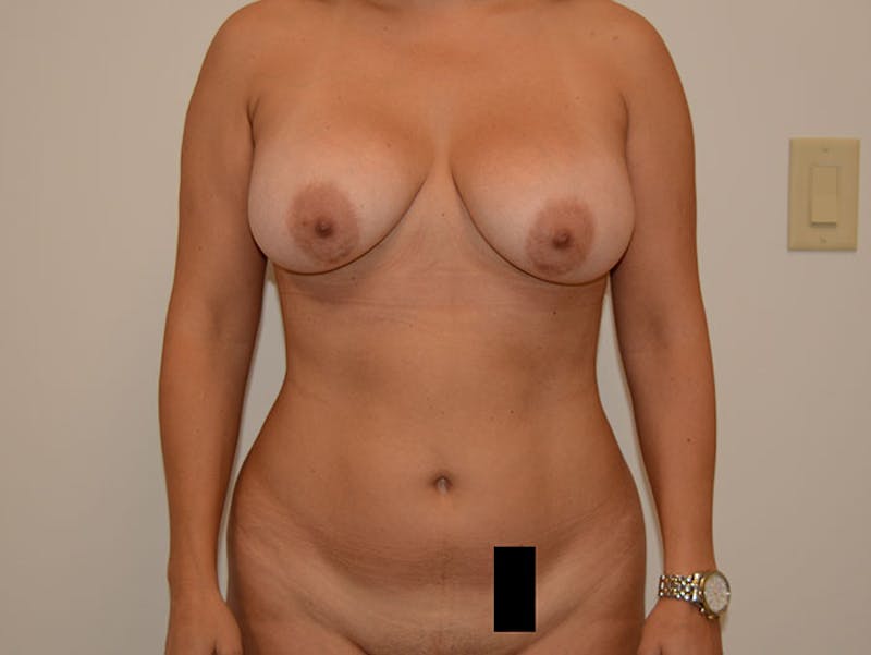 Liposuction Before & After Gallery - Patient 12917461 - Image 1