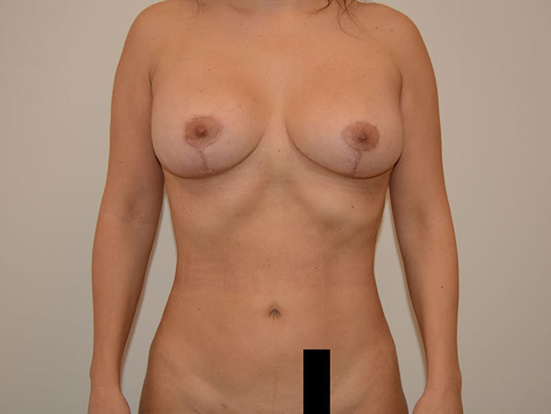 Liposuction Before & After Gallery - Patient 12917461 - Image 2