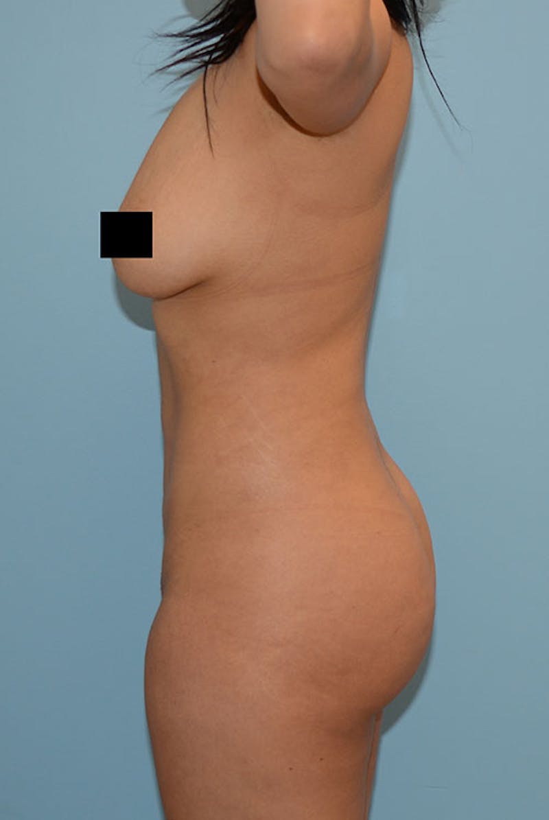 Brazilian Butt Lift Gallery - Patient 12917456 - Image 6