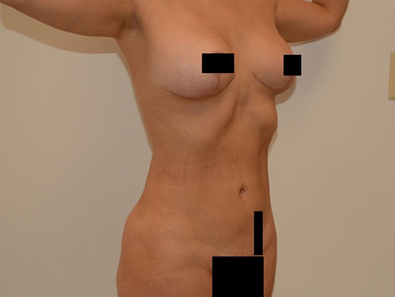 Liposuction Before & After Gallery - Patient 12917461 - Image 4