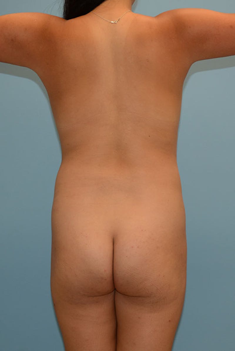 Brazilian Butt Lift Before & After Gallery - Patient 12917462 - Image 1