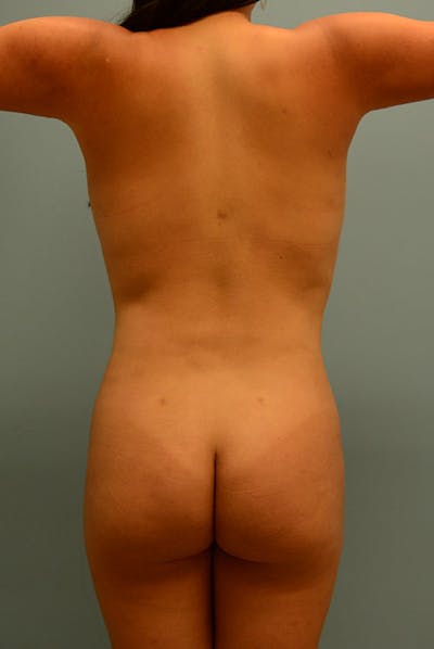 Brazilian Butt Lift Before & After Gallery - Patient 12917462 - Image 2