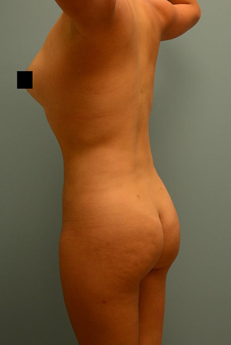 Brazilian Butt Lift Before & After Gallery - Patient 12917462 - Image 4