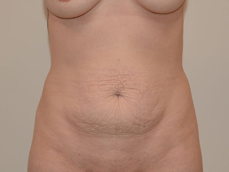 Mommy Makeover Before & After Gallery - Patient 12917465 - Image 5