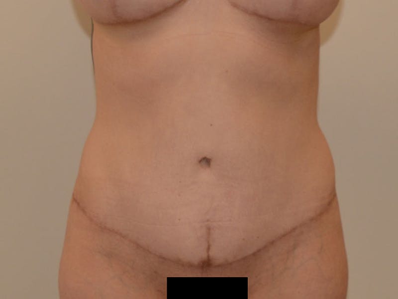 Mommy Makeover Before & After Gallery - Patient 12917465 - Image 6