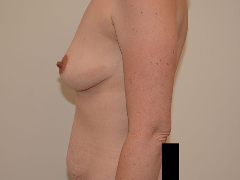 Mommy Makeover Before & After Gallery - Patient 12917465 - Image 7