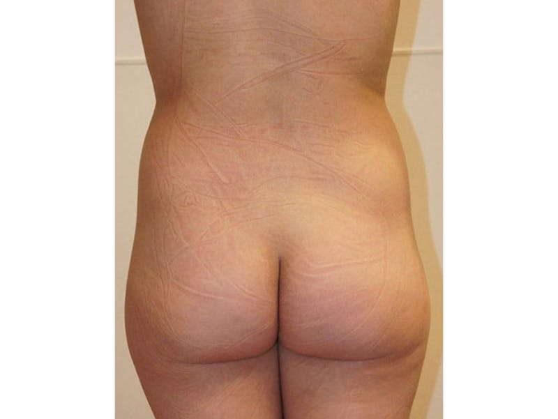 Liposuction Before & After Gallery - Patient 12917472 - Image 1